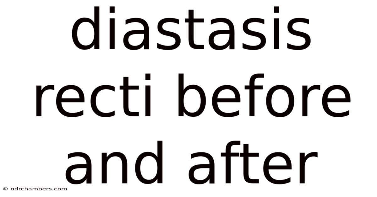 Diastasis Recti Before And After